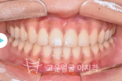 치료후기 이미지